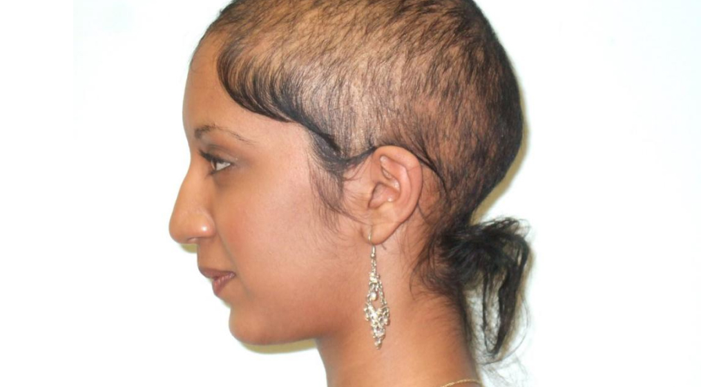 Выпадение волос на голове у женщин, причины и лечение